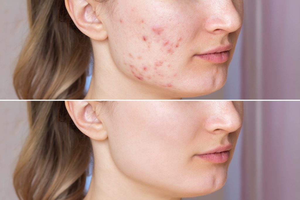 The Truth About Skin Purging vs Breakouts