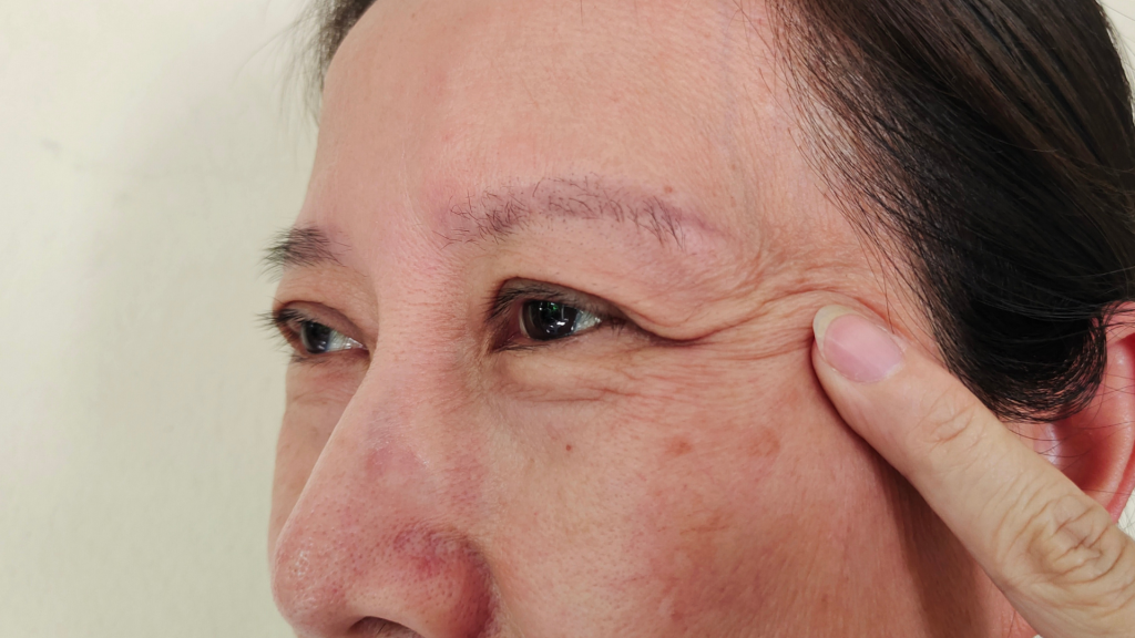 A close-up of a patient's eye area at Prime MedSpa in Vancouver, WA, highlighting fine lines and crow's feet for a clinical skin assessment.